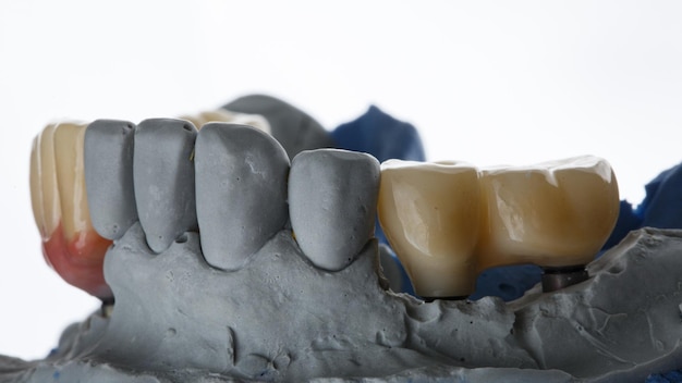 Dental Bridges